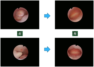 子宮鏡下手術（TCR）の例（筋腫およびポリープ）