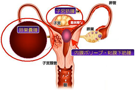 卵管障害