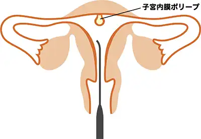 子宮内膜ポリープのイメージ