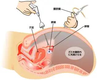 腹腔鏡下手術のイメージ