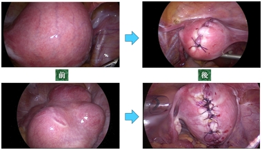 腹腔鏡下手術のイメージ