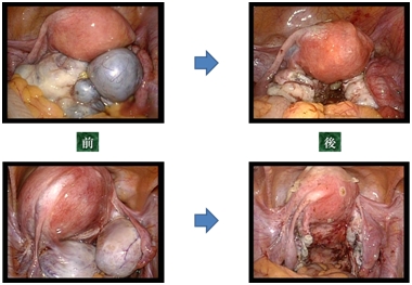 腹腔鏡下手術のイメージ