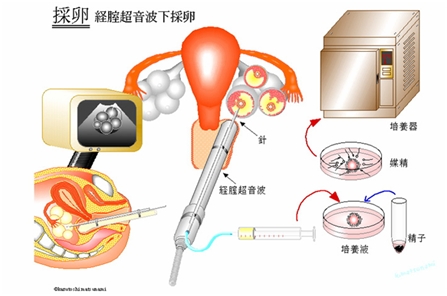 採卵