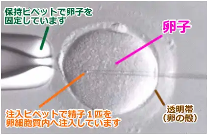 顕微授精とは