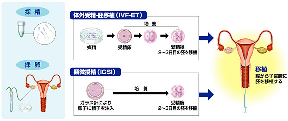 体外受精とは