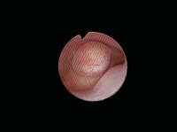 粘膜下子宮筋腫