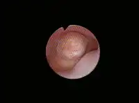 粘膜下子宮筋腫