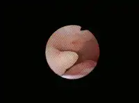 正常の子宮内腔