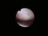 粘膜下子宮筋腫