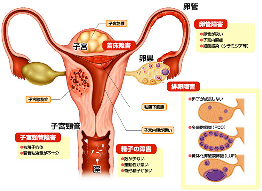 排卵障害・卵成熟障害